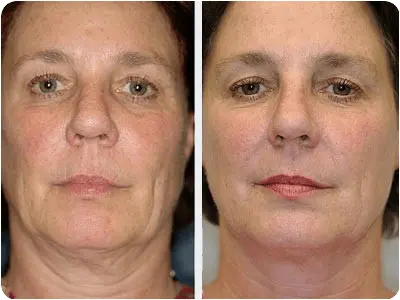 NMN-supplement-before-after-effect